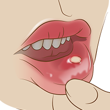 口腔の炎症